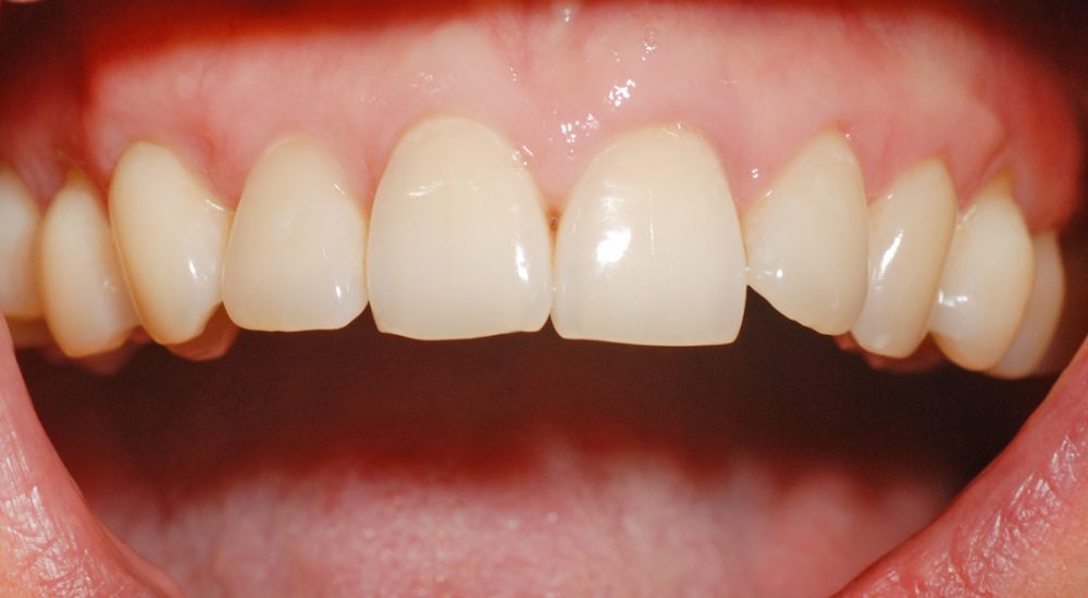 Dr. Walter Trier Mukogingivalchirurgie