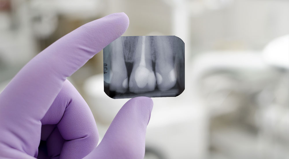 Wurzelspitzenresektion